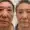 eye bag removal surgery