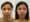 best acne extraction clinic