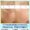 laser treatment for pigmentation