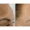 skin pigmentation treatment in kl