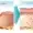 co2 laser stretch mark removal