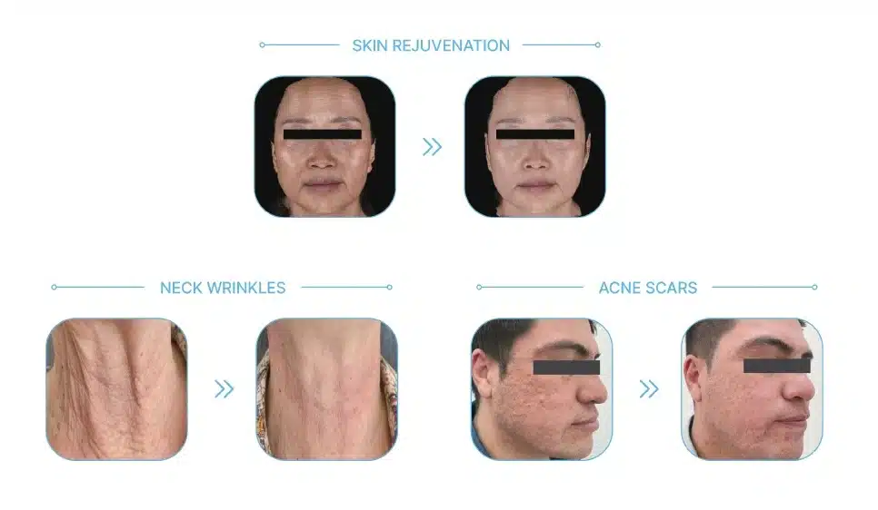 Juvelook before and after malaysia