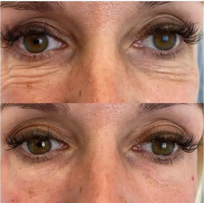 juvelook treatment before and after