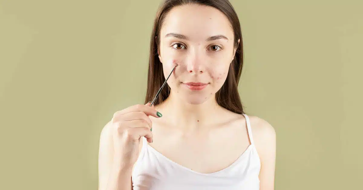 best acne treatment in KL, malaysia