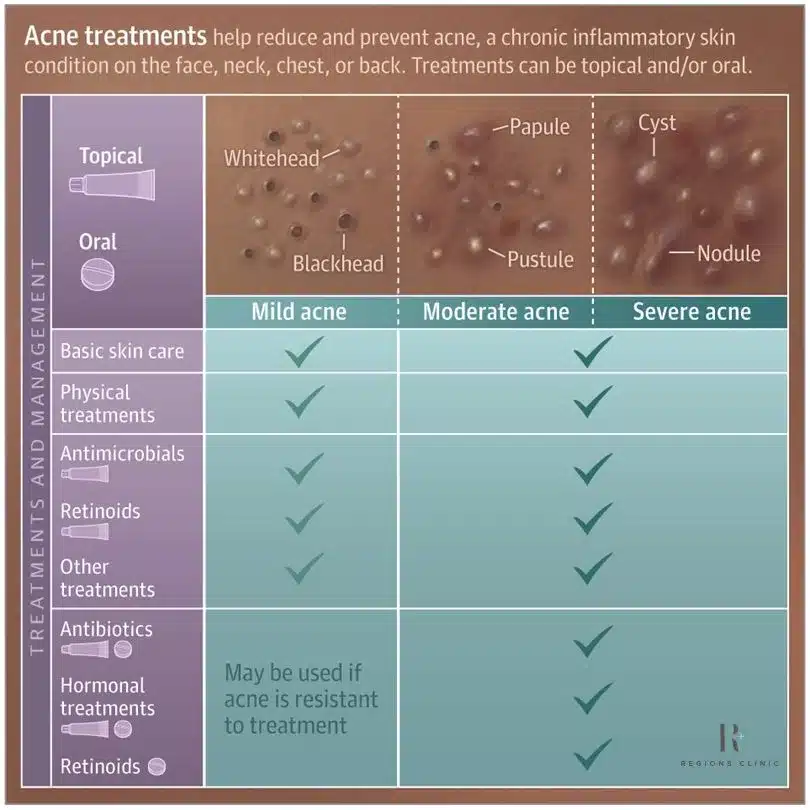 types of acne