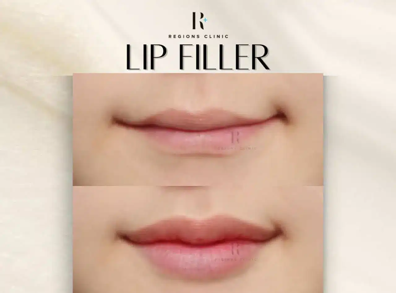 lip filler 1