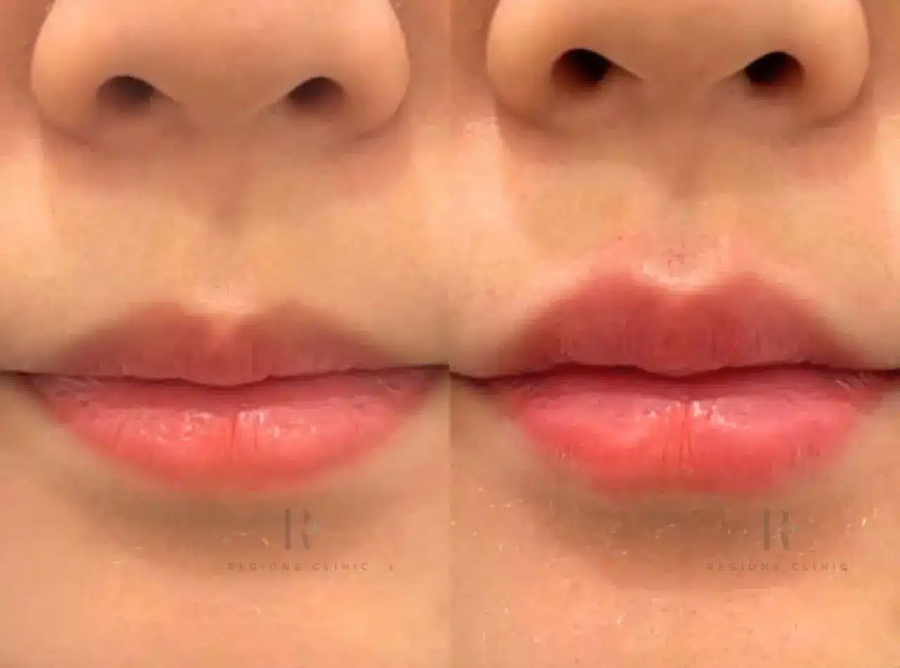 lip filler 12