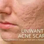 Acne Scar Treatment Malaysia