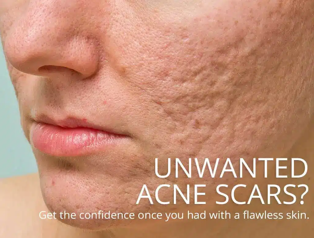 Acne Scar Treatment Malaysia