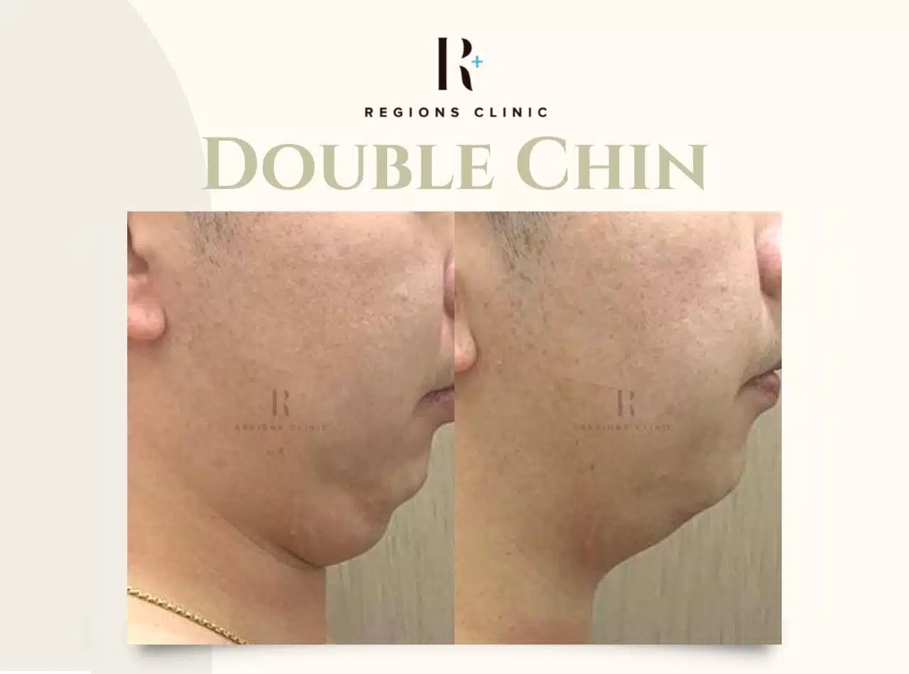 Double Chin 1