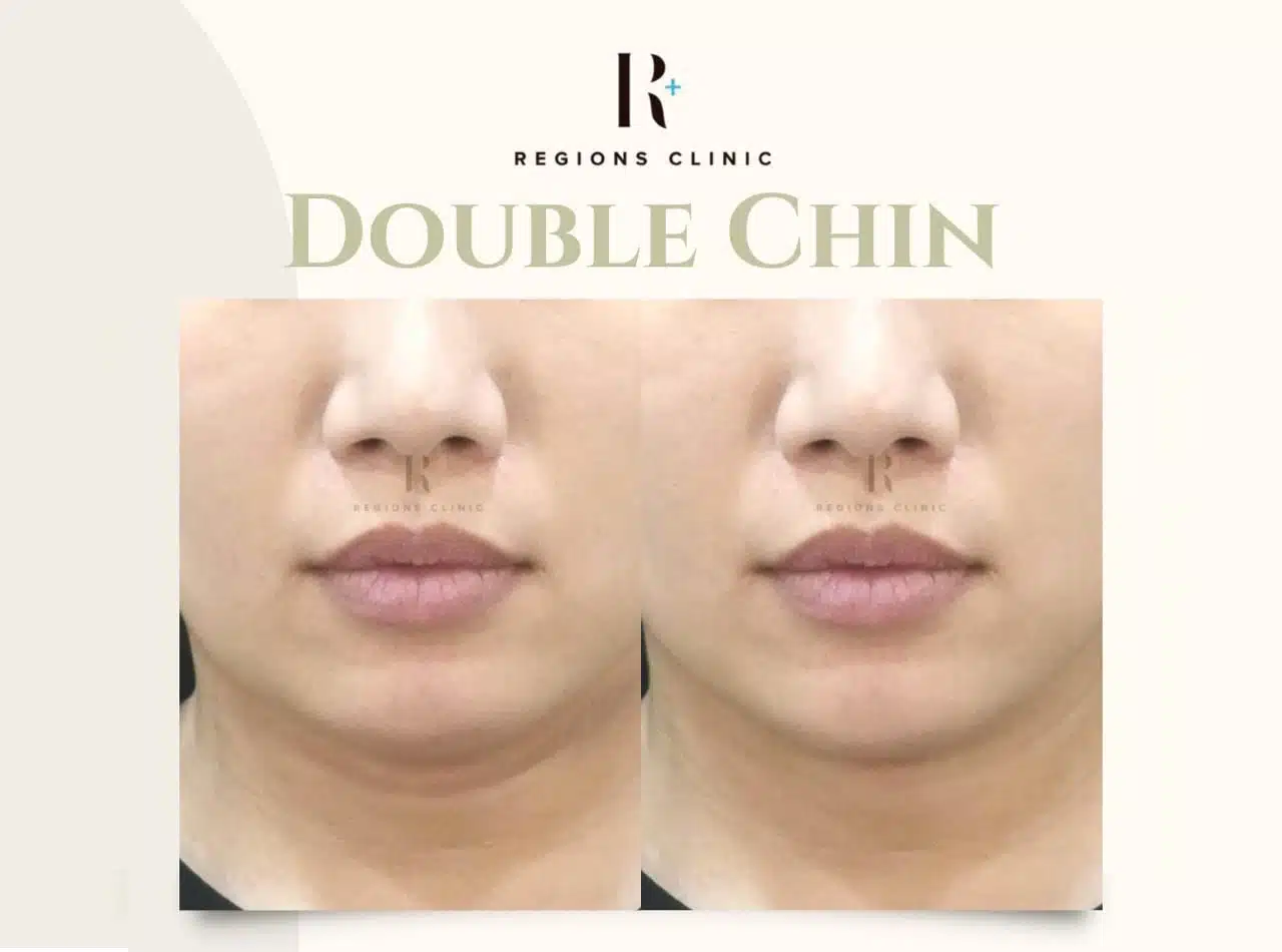 Double Chin 3