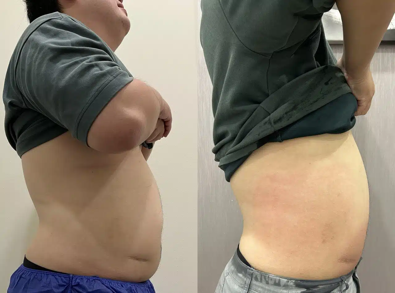 Fat Freezing 1