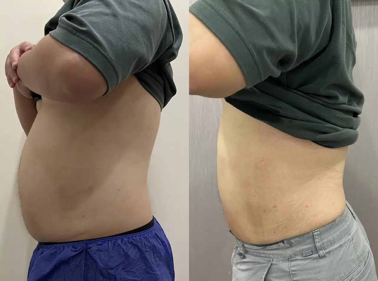 Fat Freezing 3