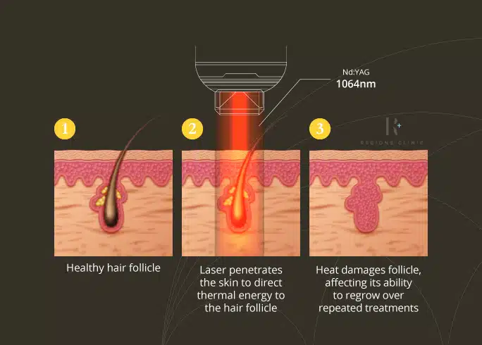 How Laser Hair Removal works