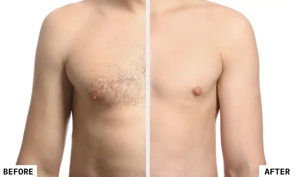 Laser Hair Removal Before and After 1