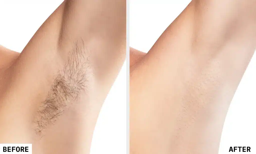 Laser Hair Removal Before and After 2