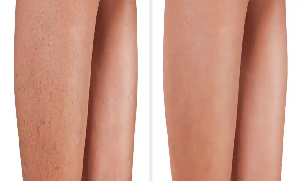 Laser Hair Removal Before and After 3