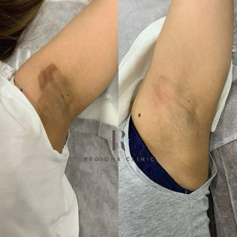 Armpit Whitening Treatment KL