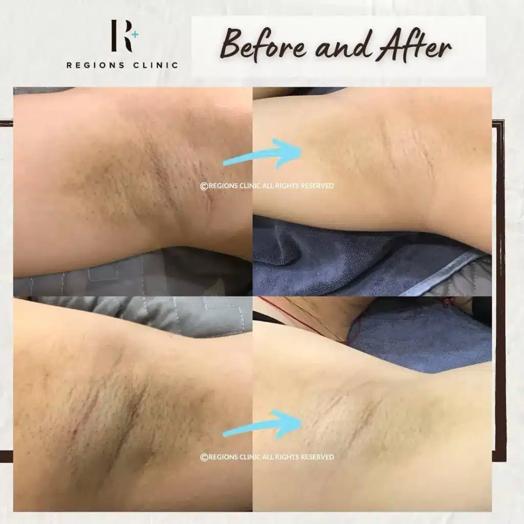 Armpit Whitening Treatment Malaysia