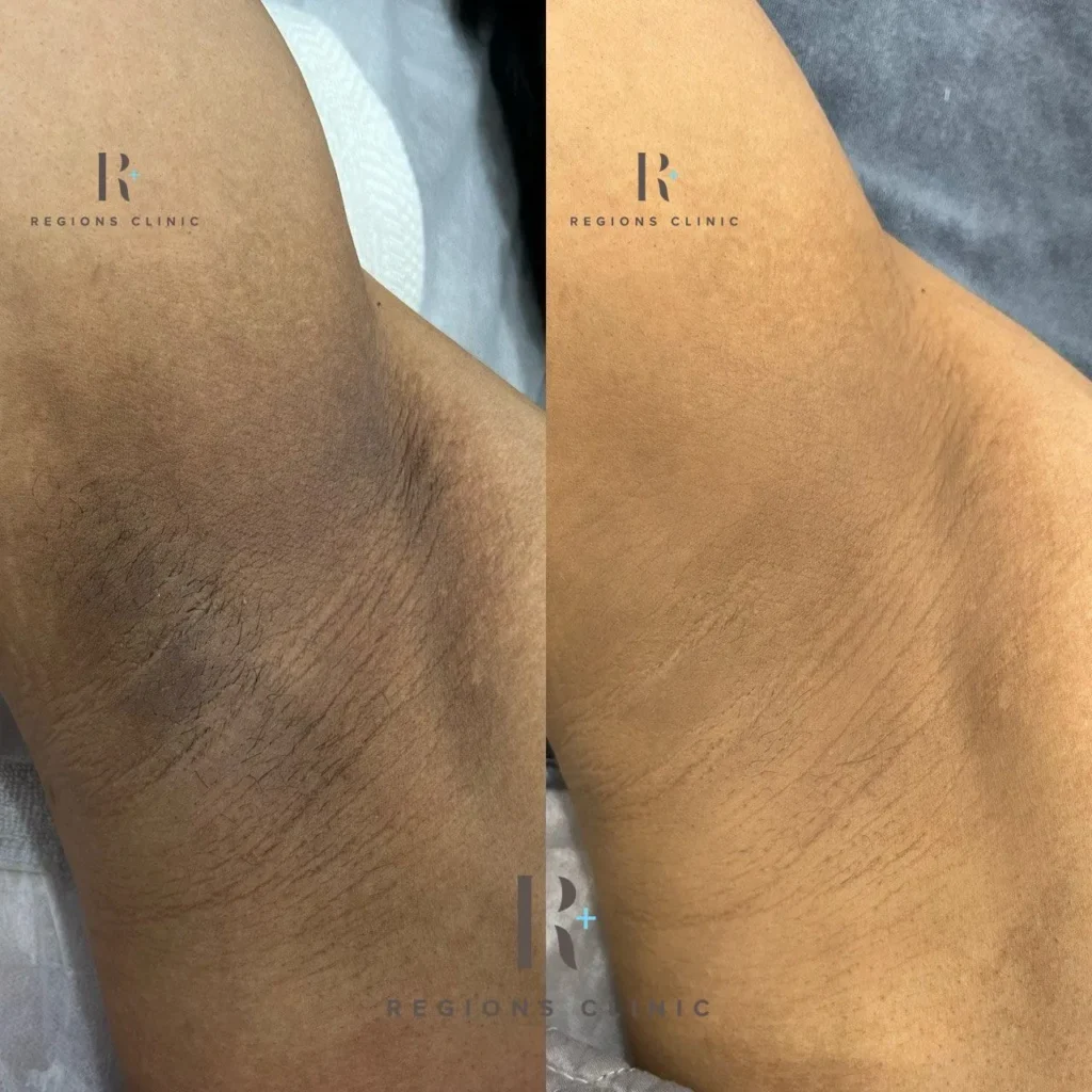 Armpit Whitening Laser Treatment