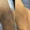 Armpit Whitening Laser Treatment