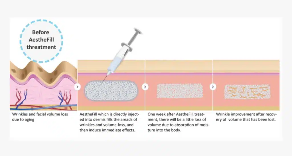 Aesthefill Treatment KL