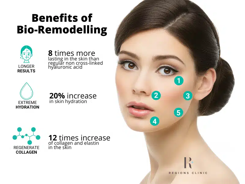 Benefits of Profhilo Injection