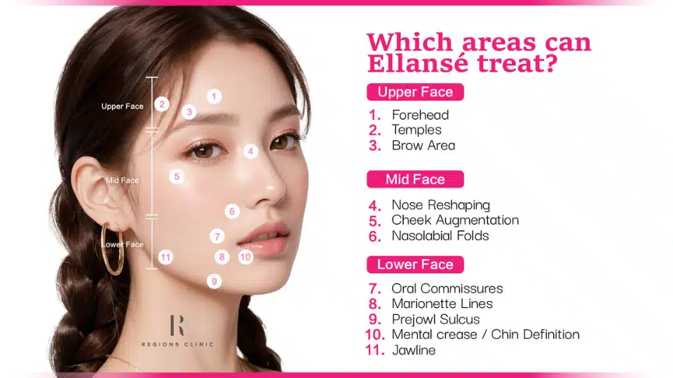 Ellanse For Collagen Stimulation in Malaysia