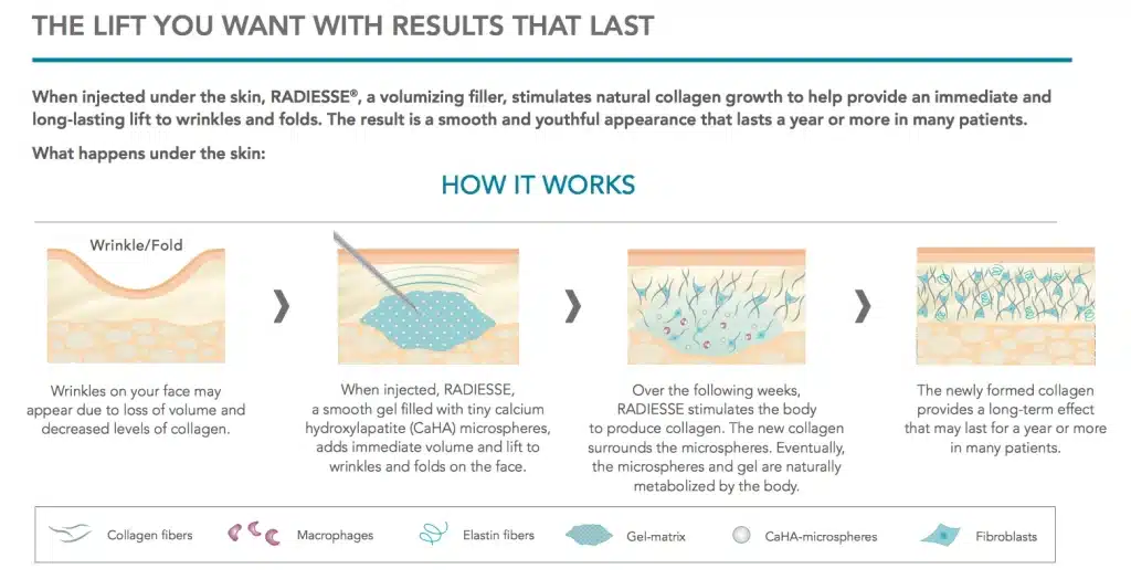 How Radiesse Filler Works