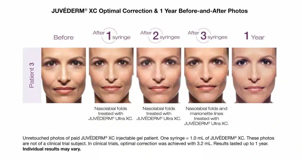 Juvederm Filler Injection Before and After