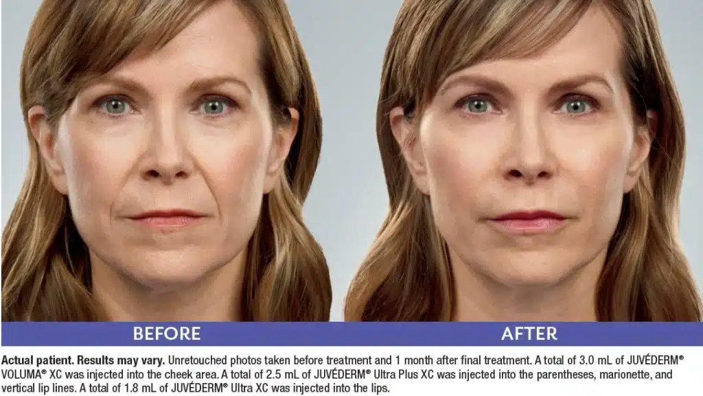 Juvederm Voluma Before and After