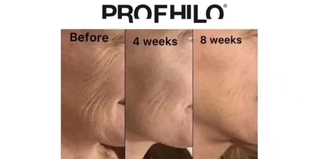 Profhilo Injection Before and After
