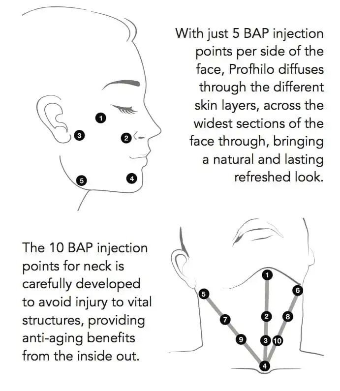 Profhilo Treatment in Malaysia