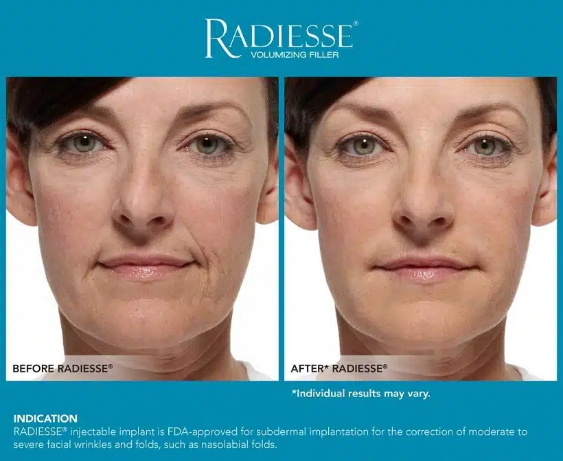 Radiesse Filler Injection Before and After