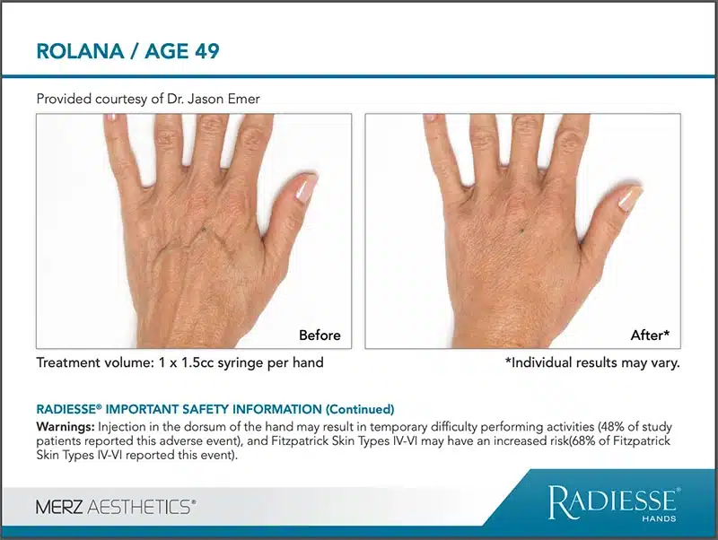 Radiesse Filler Treatment on Hands