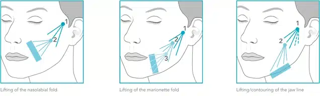 Radiesse Filler for Face Lifting