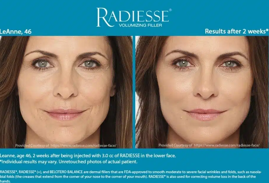 Radiesse Treatment Before and After