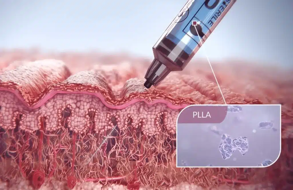 Sculptra PLLA Injection Stimulating Natural Collagen