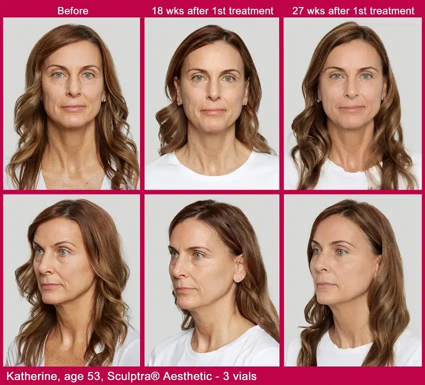Sculptra Before and After