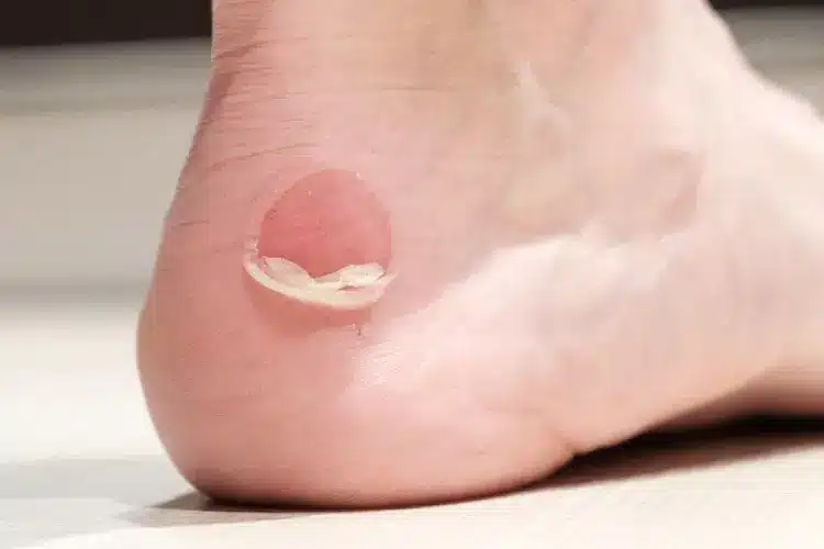 Blister Treatments in Malaysia