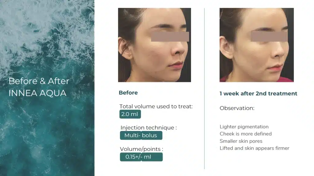 Innea Aqua Before and After 3