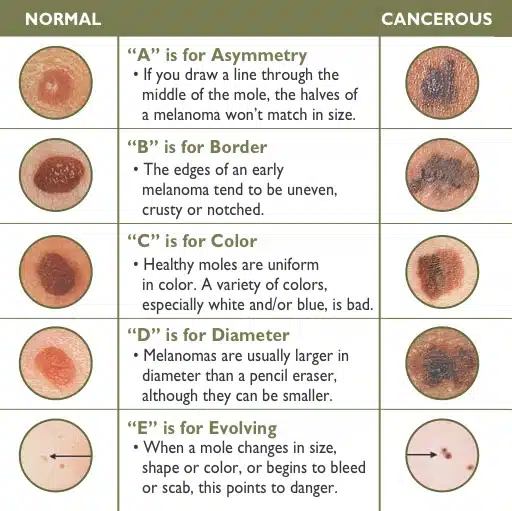 how to remove moles