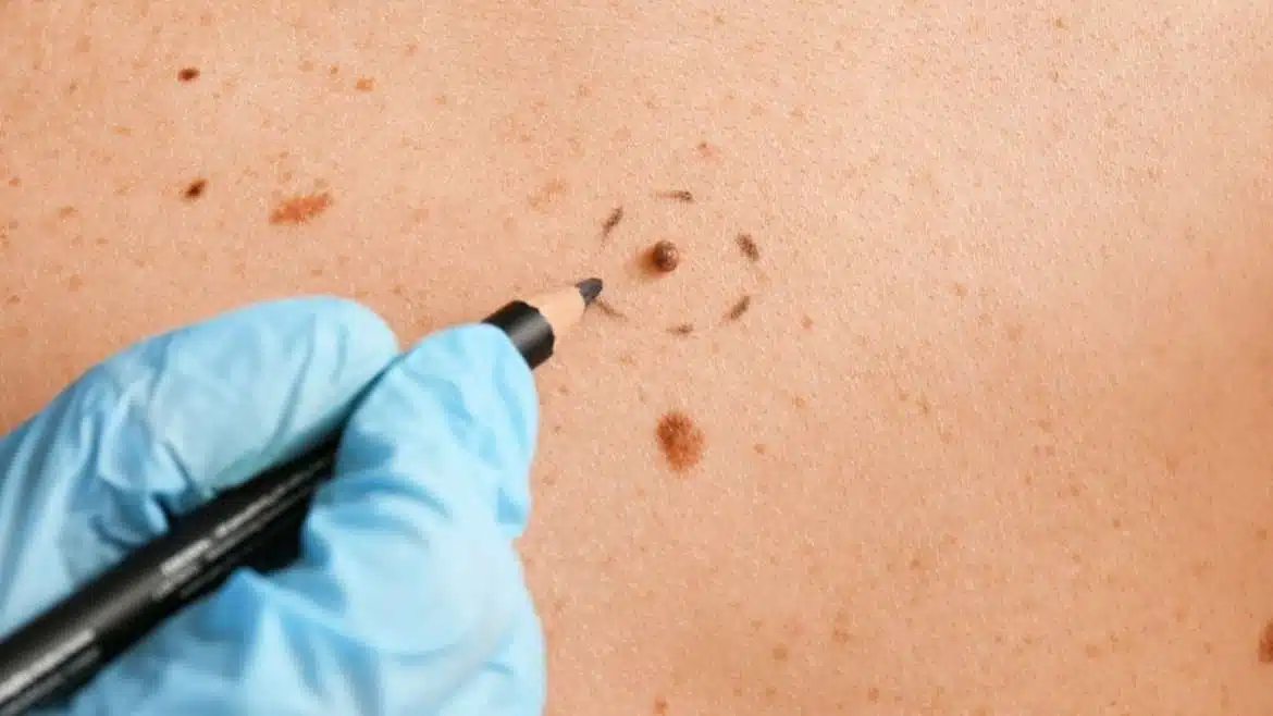 mole removal in malaysia