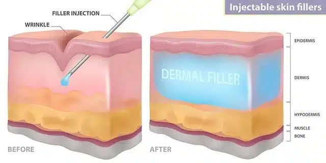 Restylane Filler Injection for Wrinkles