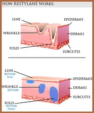 Restylane Perlane Injection