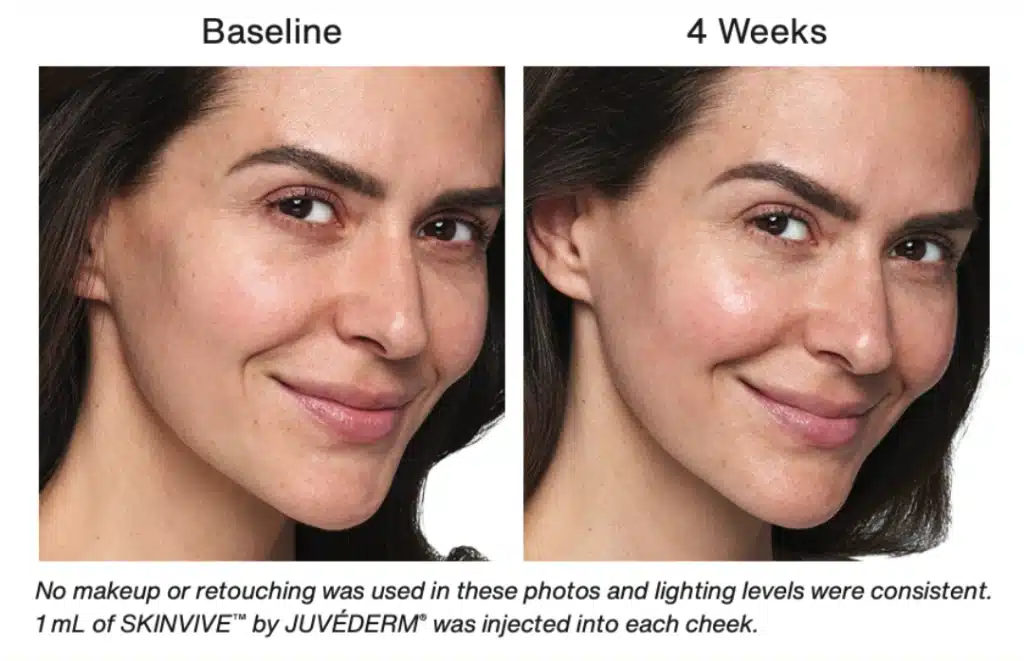 skinvive before and after