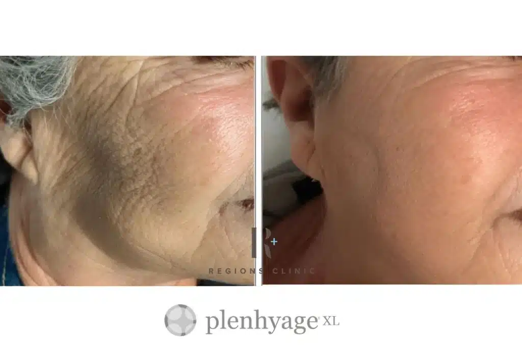 Plenhyage Before and After Treatment Results