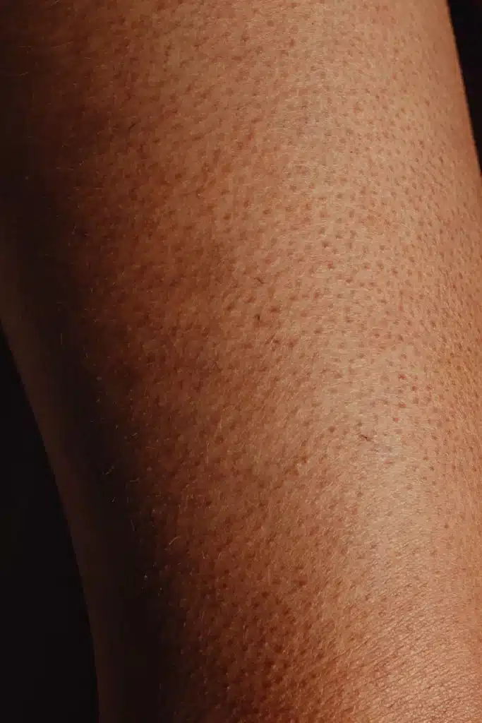 Best Keratosis Pilaris Treatment Clinic