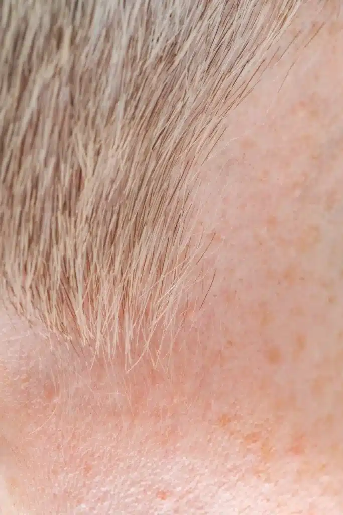 Keratosis Pilaris Face