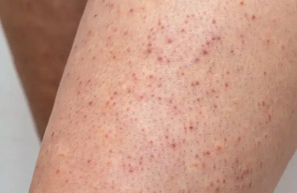 Keratosis Pilaris Treatment Malaysia